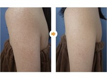 スリリアン 銀座/★お客さまビフォーアフター★