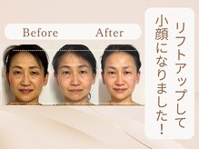 美カナエル(美kanaeru)/シミケア＆小顔ケアに変更