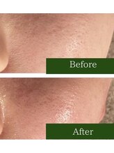 ミミー/毛穴ケアでザラつき・開きにも