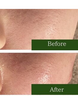 ミミー/毛穴ケアでザラつき・開きにも