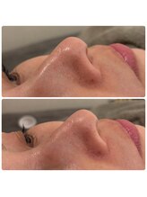 ネオファースト 大阪福島店(NeoFirst)/美容液で洗う毛穴吸引#毛穴洗浄