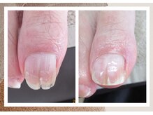 ルポ(REPOS)/割れ爪ケア