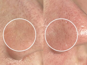 エモーショナル 姫路(Emotional)/毛穴エクストラクション