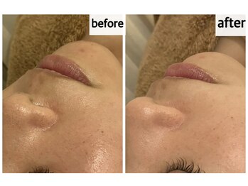 メナードフェイシャルサロン 岐阜茜部/毛穴ケア/肌荒れ/乾燥