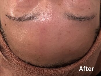 ダイヤモンド リーエンダ(Diamond leende)/クレイハーブピーリング