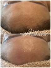 エルール トータルビューティ(Aileure total beauty)/インディバフェイシャル