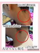 サロンシャイン(Salon Shine)/うなじ脱毛の効果