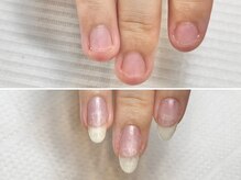 グラシュータン(gracieux temps)/深爪矯正