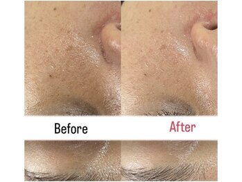 ハイコガオ 中崎町店(HIKOGAO)/全顔ハイドラ×プラズマ