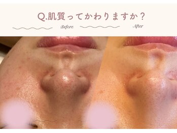 オートクチュール エステティックサロン シーズ/Q.肌質って変わりますか？