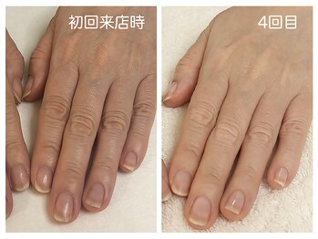 キレイテ 福岡天神店/関節のシワ、ゴツゴツがお悩み