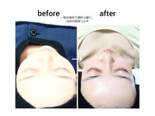 モナと雲と楽/1度の施術で劇的変化