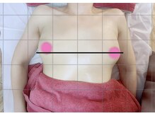 フルーブラン(Frubran)/【光フォト】豊胸バストアップ