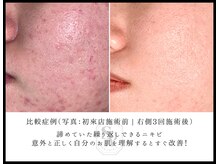 韓国肌管理室 ソア(soa)/【ニキビも任せてください】