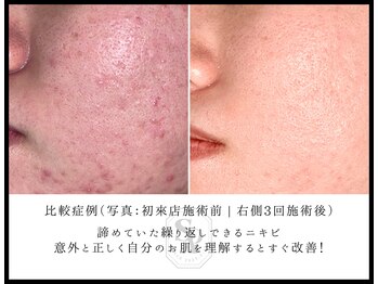 韓国肌管理室 ソア(soa)/【ニキビも任せてください】