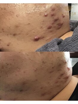 ピアーノ(PIANO)/エルモサハーブピーリング