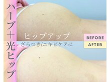 Cスキンケアクリニック 麻布店/ヒップハーブ＋光BeforeAfter