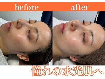 パールホワイトニングサロン 小田原店/くすみ/毛穴/韓国美容ララピール