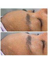 ココロニコル 今治店/水光肌　おでこwax