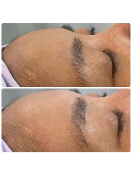 ココロニコル 今治店/水光肌　おでこwax