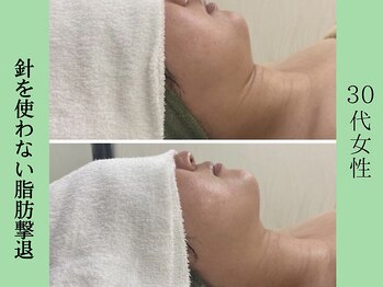 ソルニス(Solnis.)/小顔☆脂肪分解/ハイパーナイフ