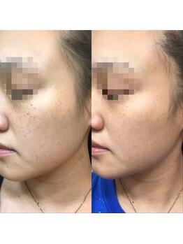 エジラランテ(esilarante)/顔脱毛