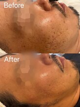 ベル 静岡(Belle)/静岡/ハーブピーリング/毛穴