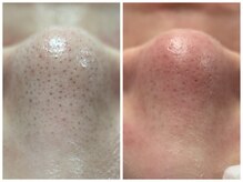 フェリス(FELIZ)/全顔丸ごと毛穴洗浄