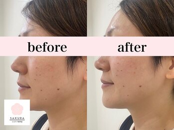 サクラ(SAKURA)/エアバリ1回体験