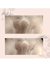 とびきりエステ 沼津店/Before→ After