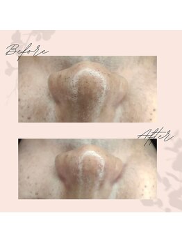 とびきりエステ 沼津店/Before→ After