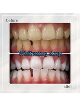 ホワイトニングショップ 岡山問屋町店/お客様のbefore&after