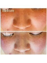 エメ(Aimer)/三重県初上陸◎WiQO水光ピール