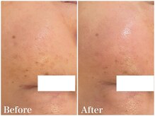 サロンドフェイス(Salon de Faith)/【ハーブピーリング】5回施術♪