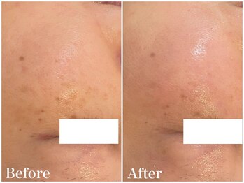 サロンドフェイス(Salon de Faith)/【ハーブピーリング】5回施術♪