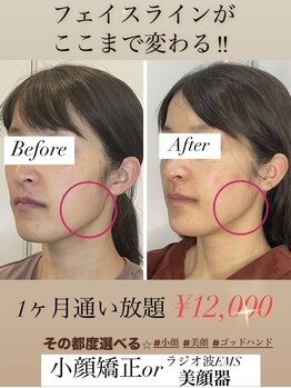 エミナル(EMINARU)/大人気!小顔矯正1ヶ月通い放題