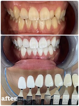 エクシアホワイトニング 札幌中島公園店/Before After［ホワイトニング］
