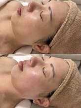 サロン ド シューナ(salon de schoner)/ハーブで叶う小顔&二重顎改善！