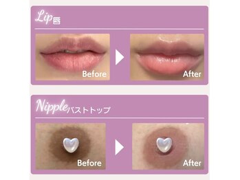 コアラル 麻布十番(COALALU)の写真/最新ピンクケア！ローマピンク正規取扱！唇バストトップVIO黒ずみくすみを本来のピンク色40％off ¥99,000