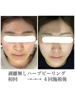 ライフ美容整体院 恵比寿(Life美容整体院)/剥離無しハーブピーリング