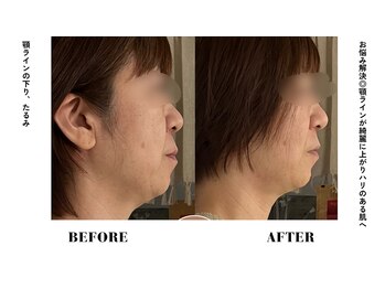 コアサロン(58SALON)の写真/【ほうれい線・たるみを引き上げ！】若々しく引き締まった理想のフェイスラインへ導きます！大人気施術◎