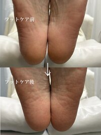 足裏角質ケア