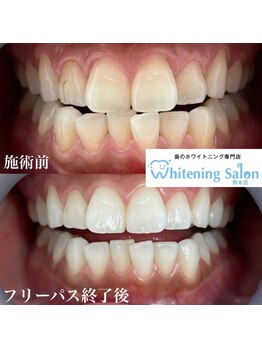 ホワイトニングサロン 熊本店/お得な価格なホワイトニング
