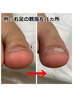 【食い込んだ巻き爪に】全ての巻き爪改善コース1本1ヵ所+歩行指導 ¥8250