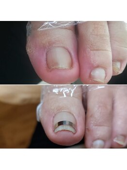 陥入が落ち着いたら