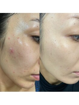 ローズジャスミン(RoseJasmine)/肌荒れ、肌トラブルに強い肌に