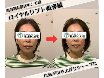 ハリカフェ(HARI CAFE)/【変化】ロイヤルリフト美容鍼