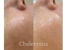 シャルル ストア 京都三条通(Chaleureux Store)/どんな肌タイプでも、毛穴レス肌