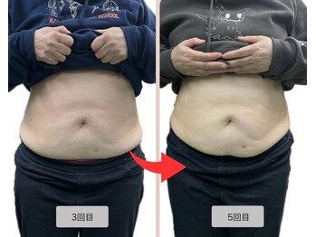 リセル(Recell)/お腹★脂肪分解