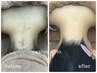 【まとめ髪が映える＊】うなじ脱毛＋お顔丸ごと脱毛 ¥12,650→¥9,900